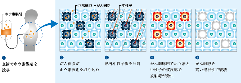 BNCTにおける治療の流れを5つのステップで解説