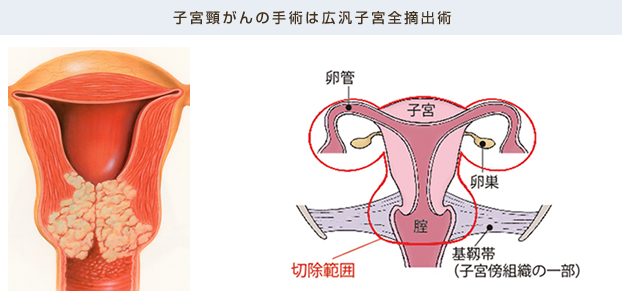 子宮頸がんの手術は広汎子宮全摘出術