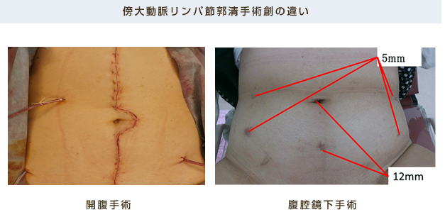 傍大動脈リンパ節郭清手術創の違い