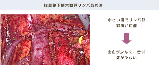 腹腔鏡下傍大動脈リンパ節郭清