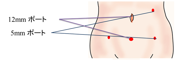 腹腔鏡下広汎子宮全摘出術の特徴