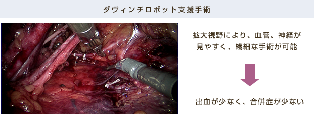 ダヴィンチロボット支援手術