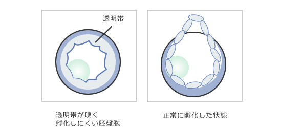 アシステッド・ハッチング