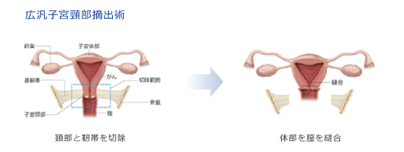 広汎子宮頸部摘出術