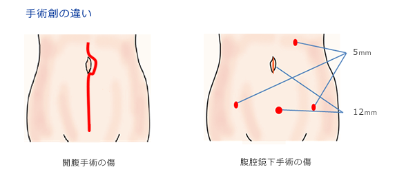 腹腔鏡下子宮体がん根治術