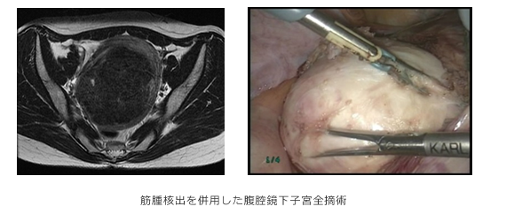 子宮筋腫