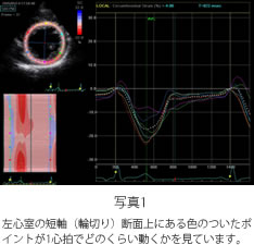 写真1　左心室の短軸（輪切り）断面上にある色のついたポイントが1心拍でどのくらい動くかを見ています。