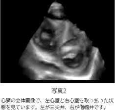 写真２　心臓の立体画像で、左心室と右心室を取っ払った状態を見ています。左が三尖弁、右が僧帽弁です。