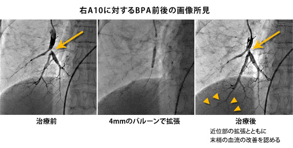 右A10に対するBPA前後の画像所見