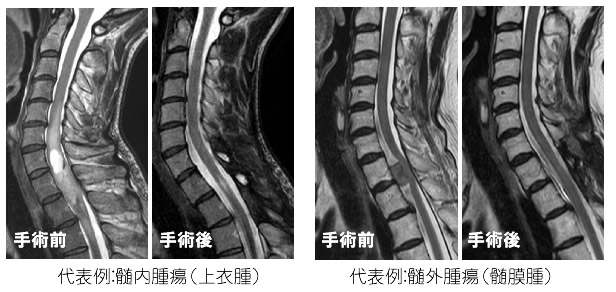 脊髄腫瘍