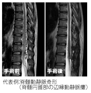 脊髄腫瘍