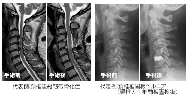 脊髄腫瘍