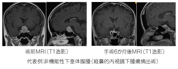 下垂体腫瘍