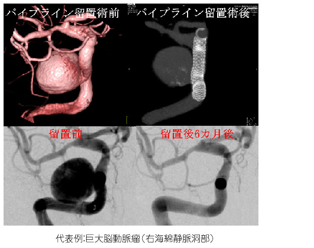 未破裂脳動脈瘤