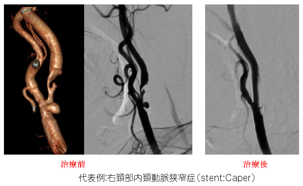 頚動脈狭窄症