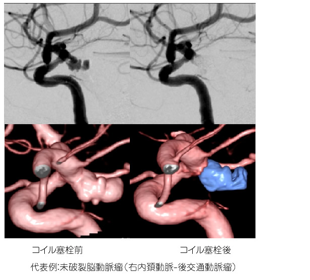 未破裂脳動脈瘤