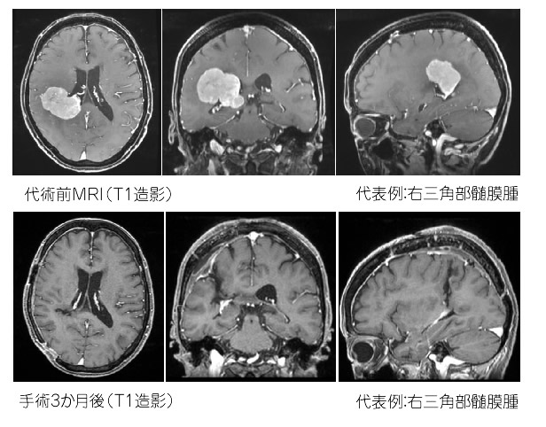 髄膜腫