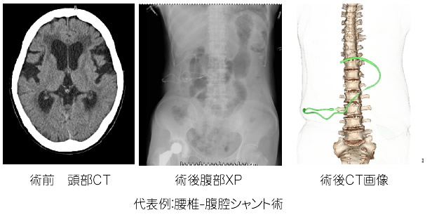 正常圧水頭症