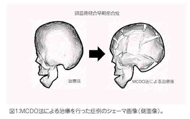 MCDO法による治療を行った症例のシェーマ画像