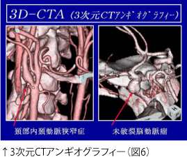 ↑3次元CTアンギオグラフィー（図6）