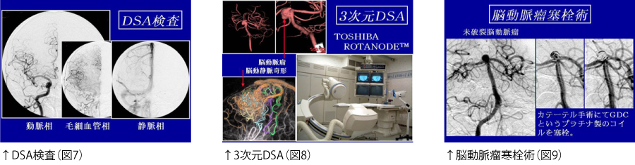 ↑DSA検査（図7）↑3次元DSA（図8）↑脳動脈瘤寒栓術（図9）