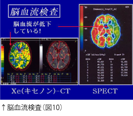 ↑脳血流検査（図10）