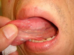 舌白板症