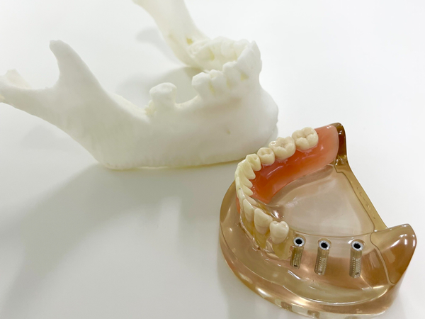 歯科インプラント治療