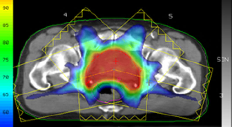 前立腺がんへ強度変調放射線治療