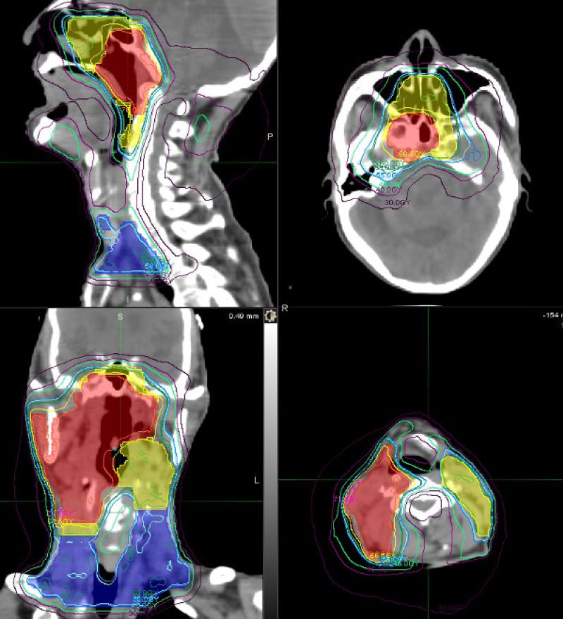 頭頸部がんのIMRT線量分布図