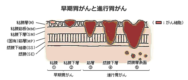 早期胃がんと進行胃がん