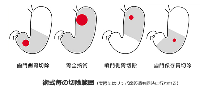 術式ごとの切除範囲