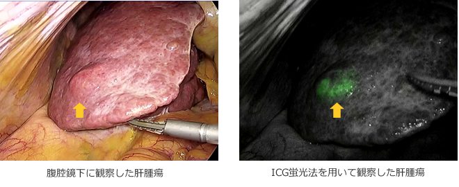 ICG蛍光法を用いて観察した肝腫瘍