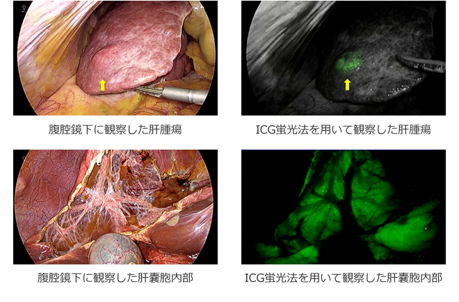 ICG蛍光法を用いて観察した肝腫瘍