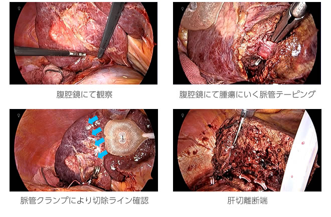 腹腔鏡にて観察  (遠景像)