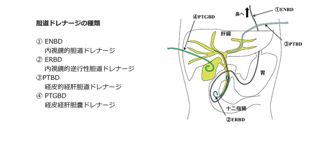 胆道ドレナージの種類