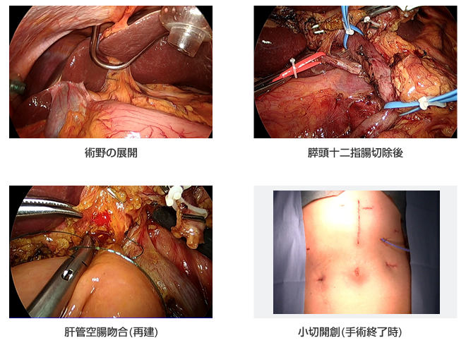 腹腔鏡補助下膵頭十二指腸切除術