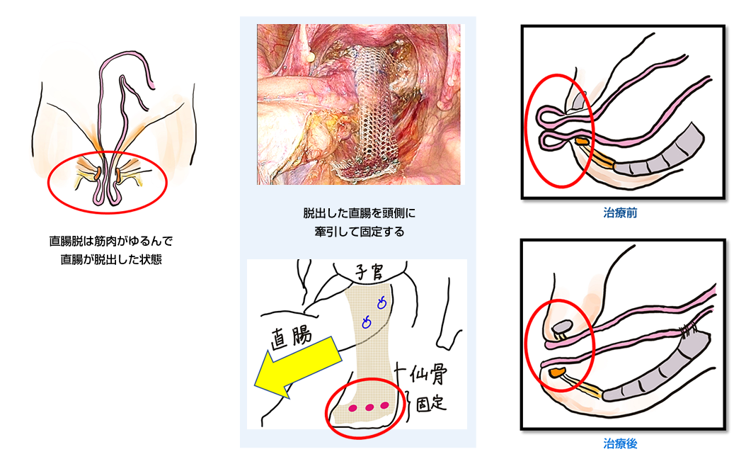 図6「括約筋部分切除併用超低位直腸切除術(究極の肛門温存術)」
