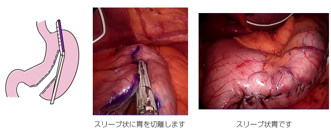 腹腔鏡下スリーブ状胃切除術