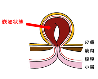 嵌頓状態