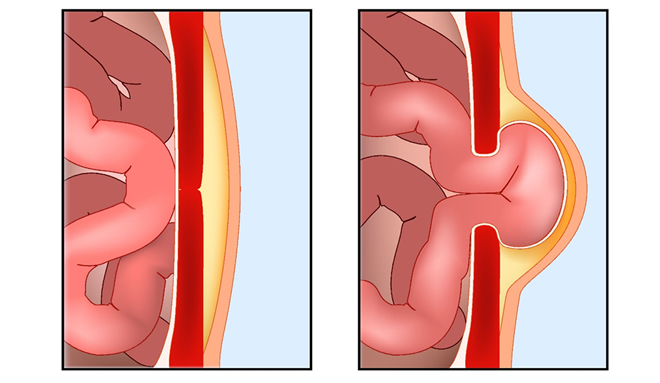 腹壁瘢痕ヘルニア