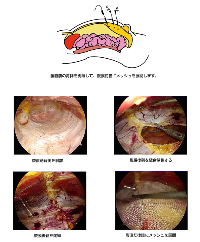 eTEP法