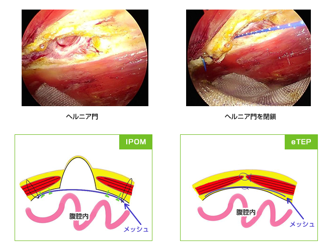 eTEP法２