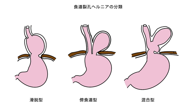 食道裂孔ヘルニアの分類