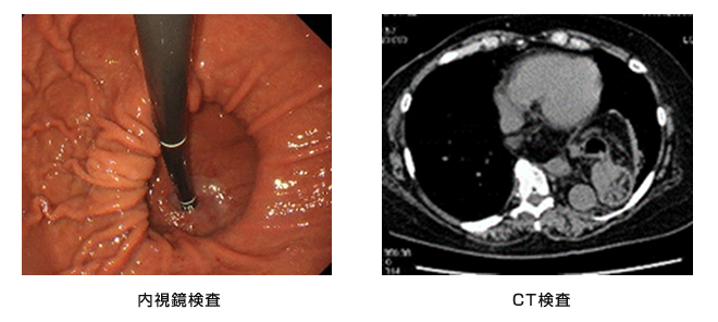 内視鏡検査・CT検査