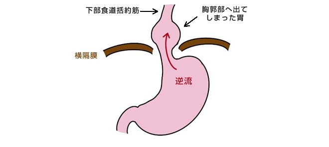 食道裂孔ヘルニアの症状