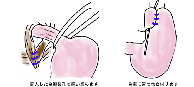 食道裂孔ヘルニアの手術