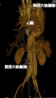 大動脈瘤
