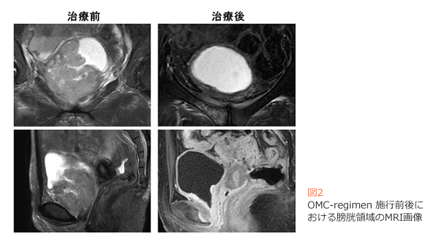 図2　OMC-regimen 施行前後における膀胱領域のMRI画像