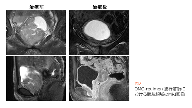 }2@OMC-regimen {sOɂN̈MRI摜